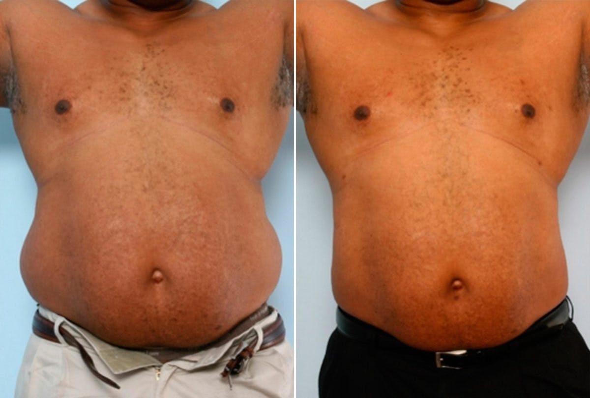 Male Liposuction Before & After Gallery - Patient 55485539 - Image 1