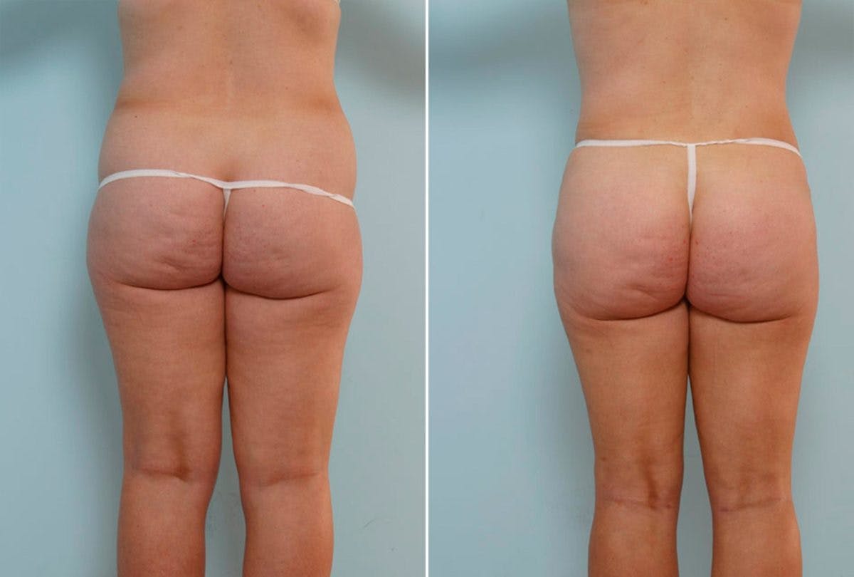 Abdominoplasty Before & After Gallery - Patient 54868622 - Image 4