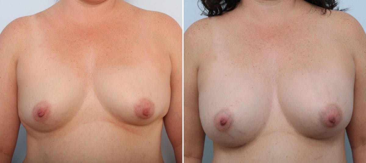 Mommy Makeover Before & After Gallery - Patient 54869376 - Image 1