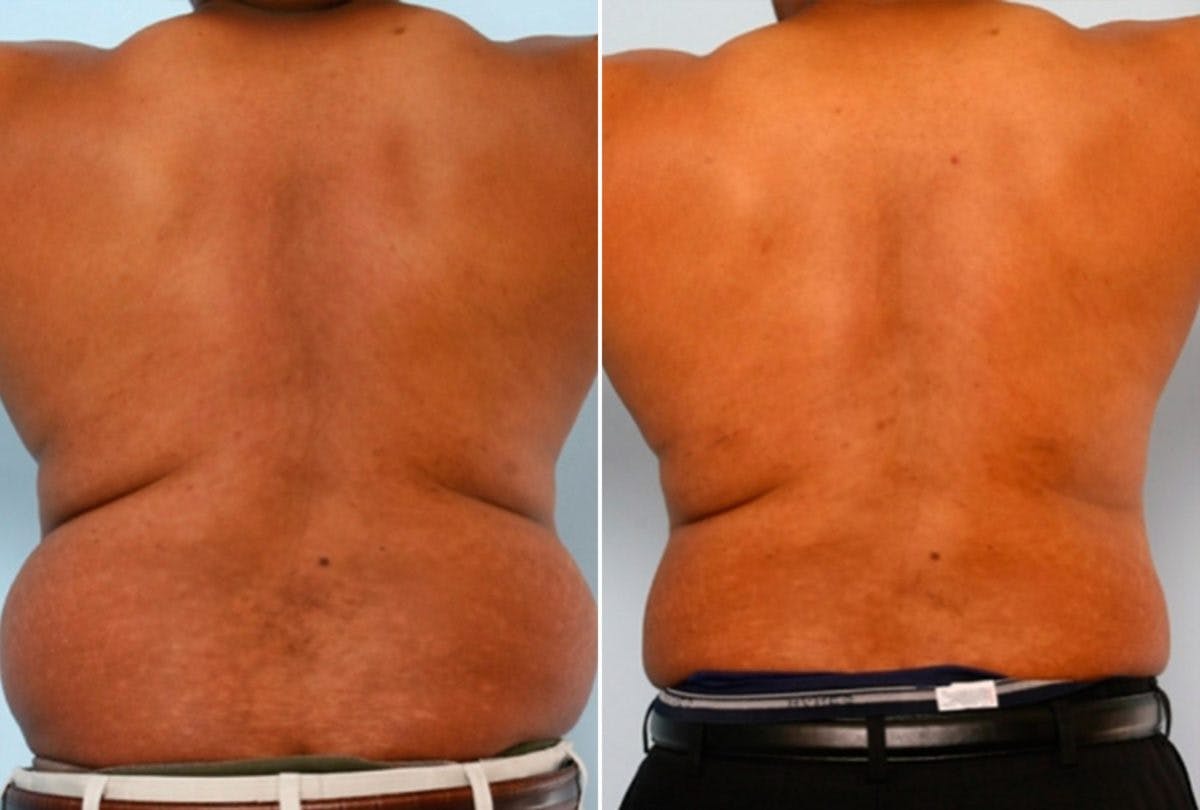 Male Liposuction Before & After Gallery - Patient 55485539 - Image 3