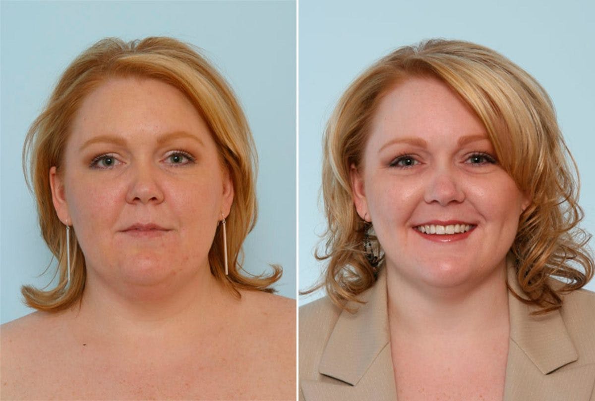 Female Liposuction Before & After Gallery - Patient 54869373 - Image 1