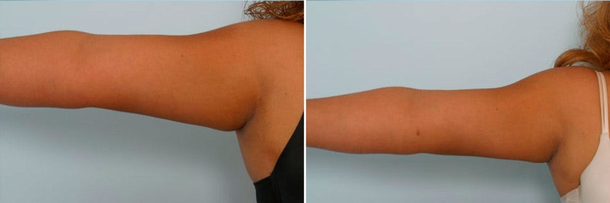 Female Liposuction Before & After Gallery - Patient 54870131 - Image 1