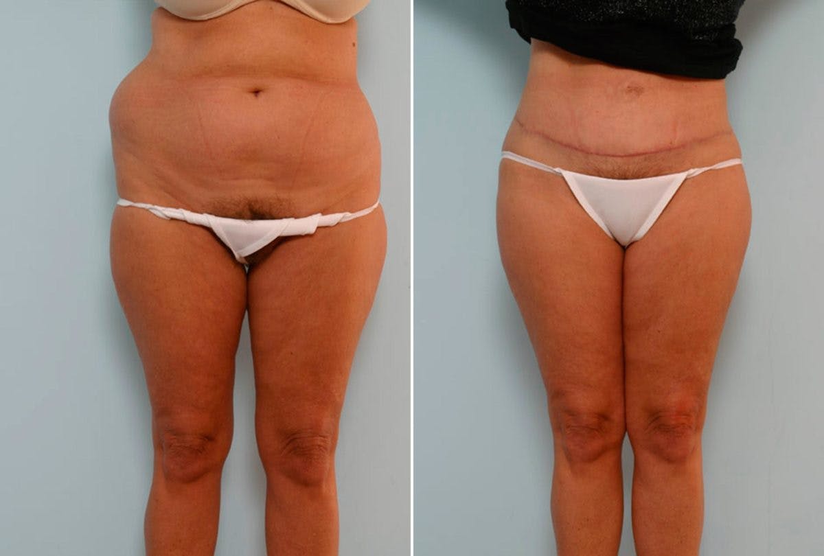 Abdominoplasty Before & After Gallery - Patient 54870133 - Image 1