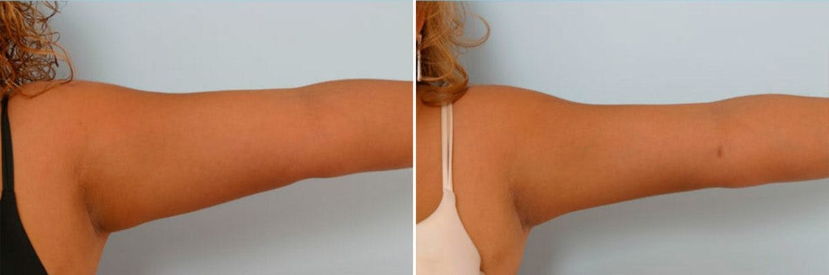 Female Liposuction Before & After Gallery - Patient 54870131 - Image 2