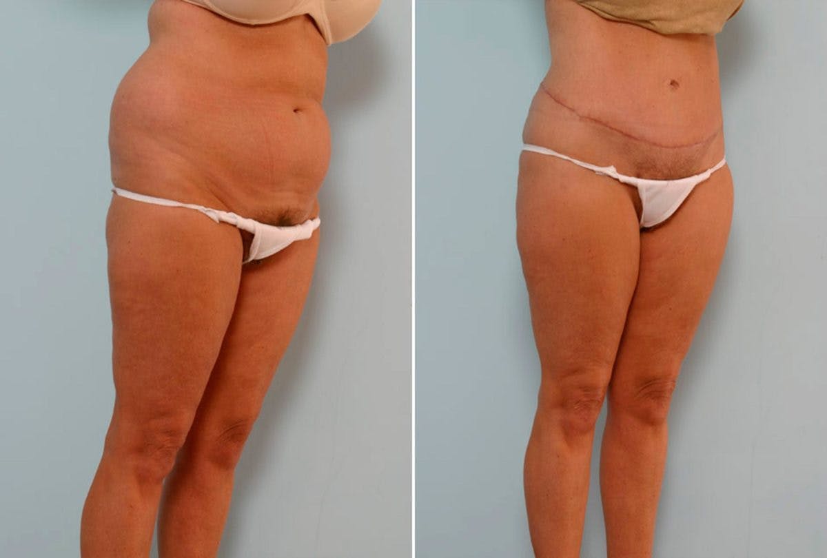 Abdominoplasty Before & After Gallery - Patient 54870133 - Image 2