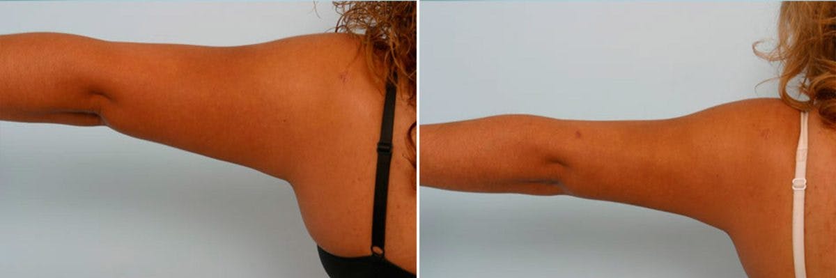 Female Liposuction Before & After Gallery - Patient 54870131 - Image 3