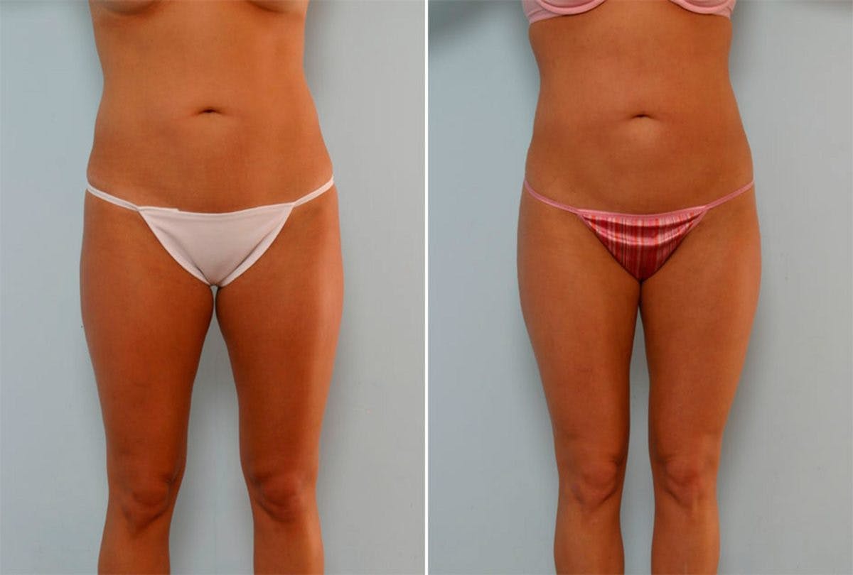 Female Liposuction Before & After Gallery - Patient 54870137 - Image 1