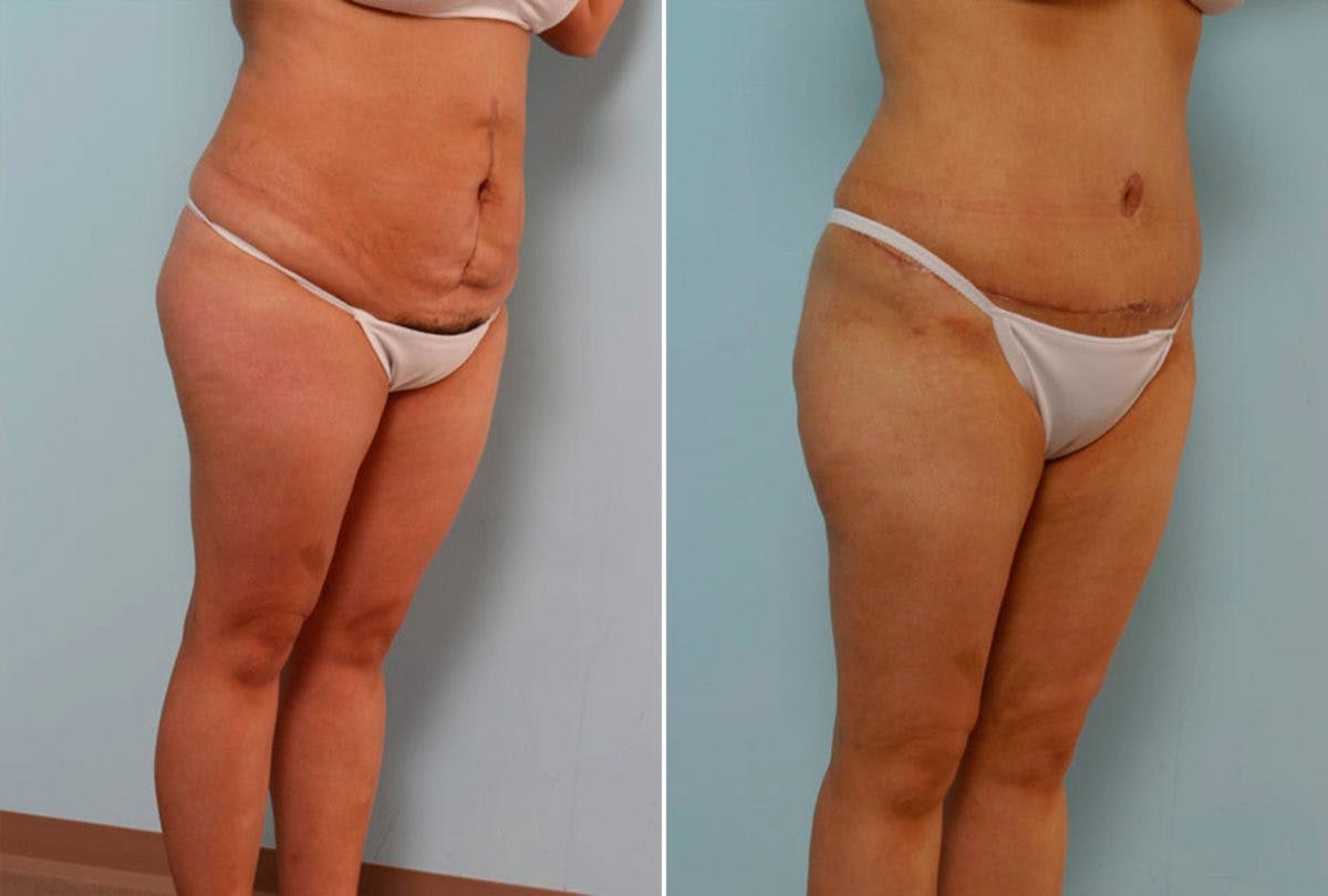 Abdominoplasty Before & After Gallery - Patient 54870139 - Image 2
