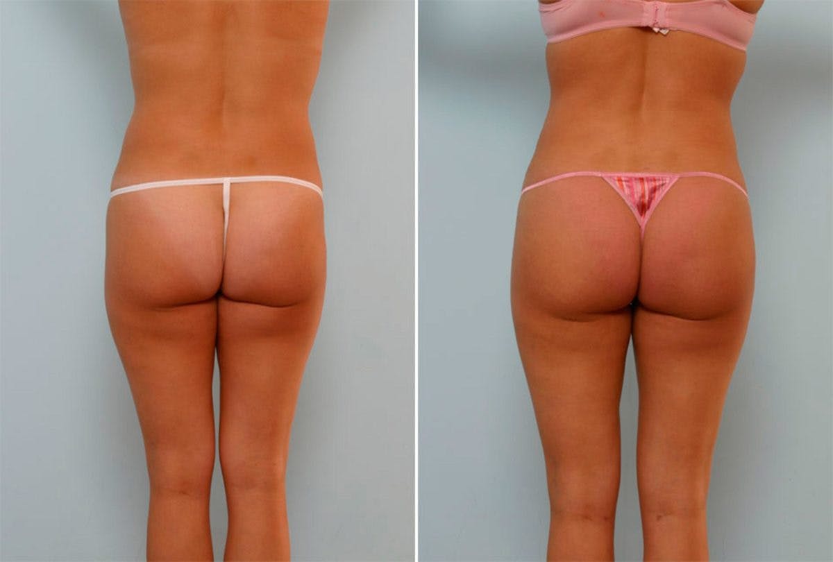 Female Liposuction Before & After Gallery - Patient 54870137 - Image 3