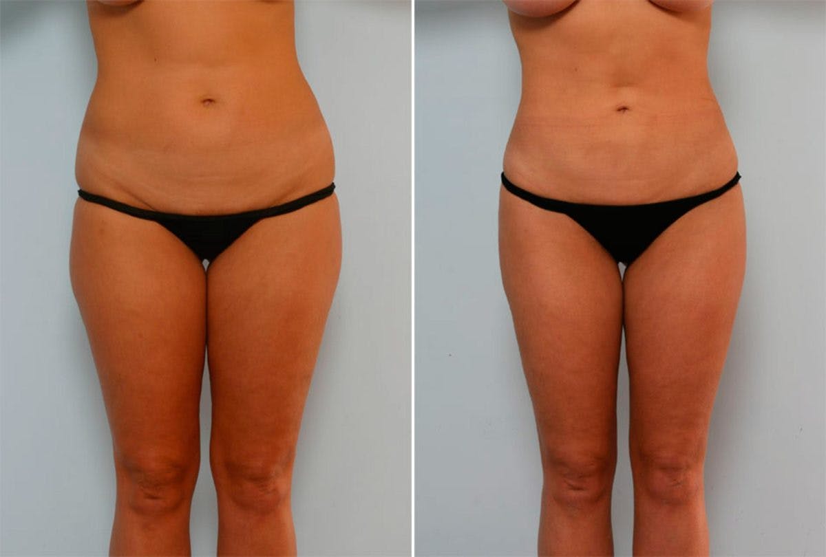 Female Liposuction Before & After Gallery - Patient 54870143 - Image 1