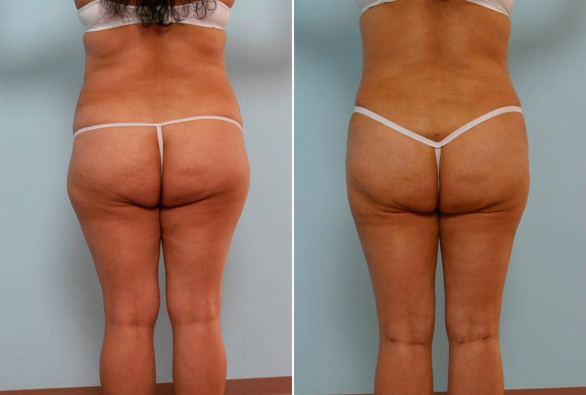 Abdominoplasty Before & After Gallery - Patient 54870139 - Image 4