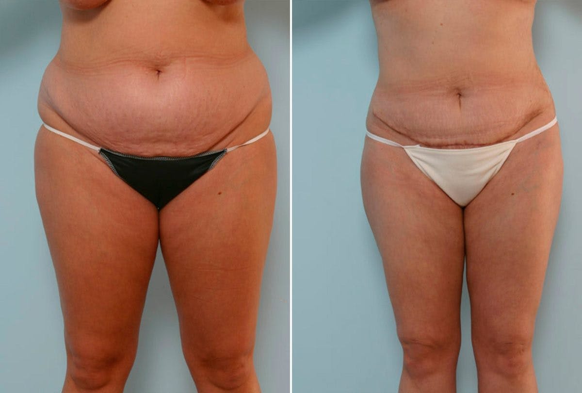 Abdominoplasty Before & After Gallery - Patient 54870142 - Image 1
