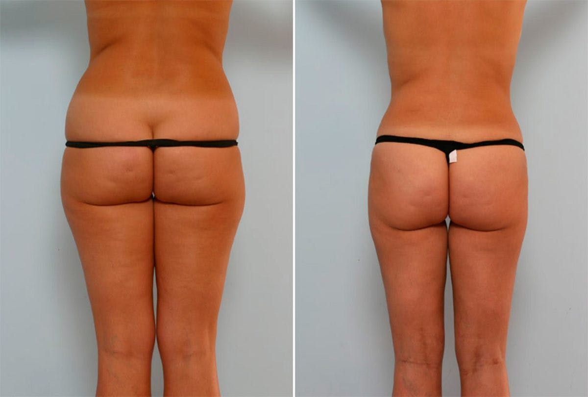 Female Liposuction Before & After Gallery - Patient 54870143 - Image 3