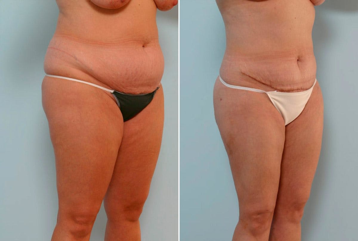 Abdominoplasty Before & After Gallery - Patient 54870142 - Image 2