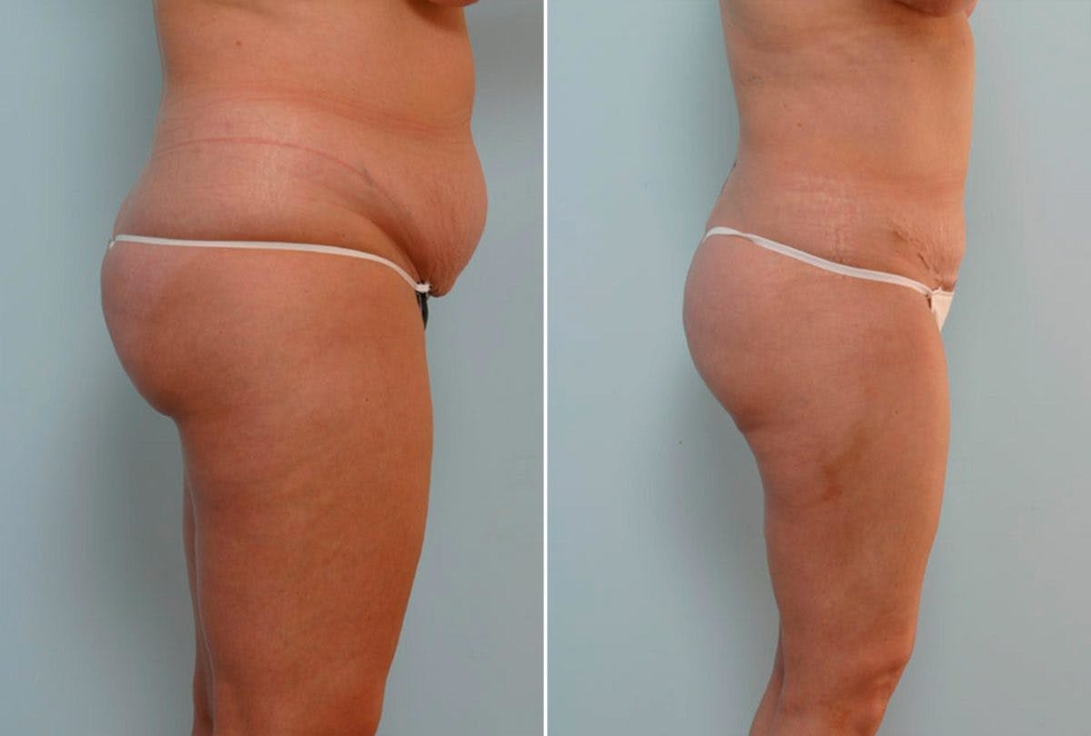Abdominoplasty Before & After Gallery - Patient 54870142 - Image 3