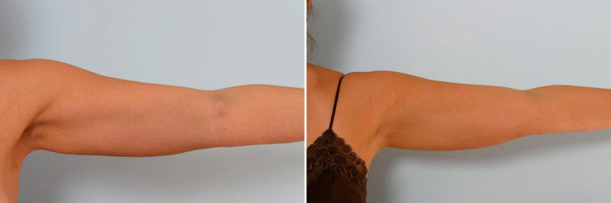 Female Liposuction Before & After Gallery - Patient 54870143 - Image 5