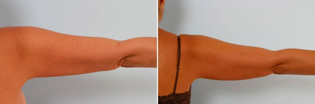 Female Liposuction Before & After Gallery - Patient 54870143 - Image 7