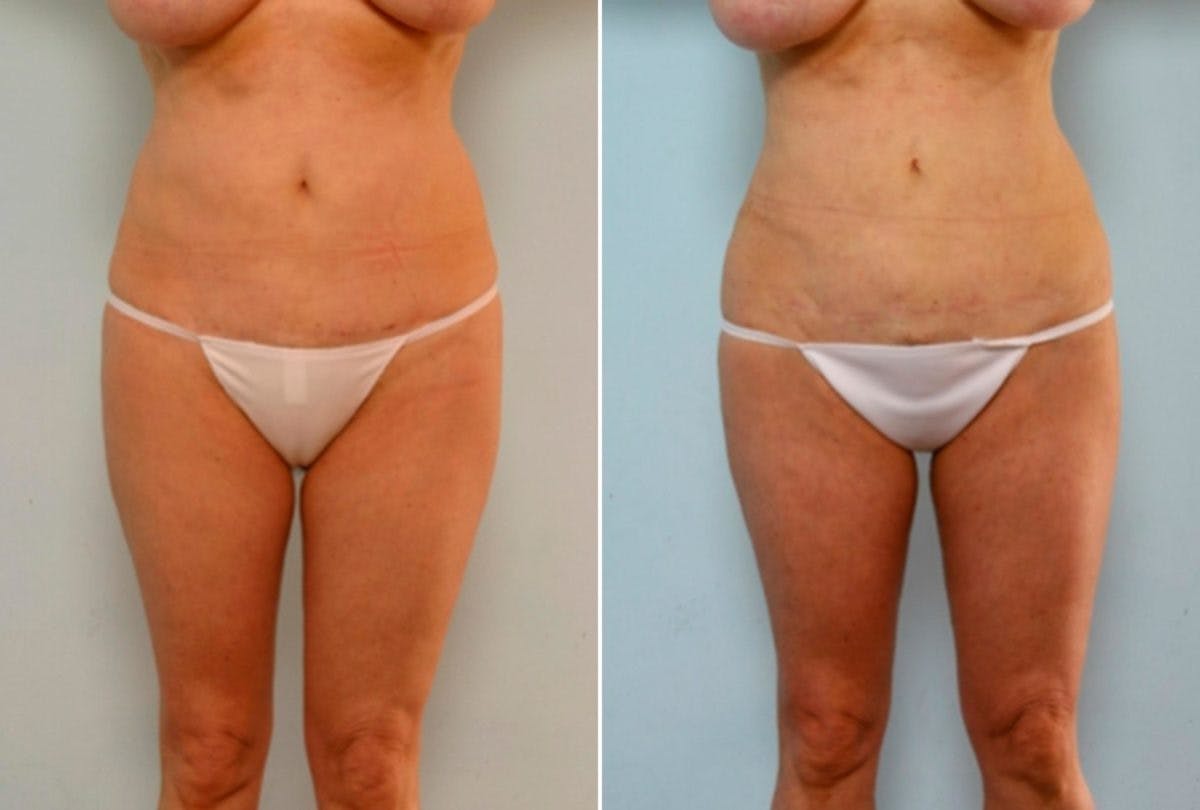 Female Liposuction Before & After Photo - Patient 54870145 - Image 1