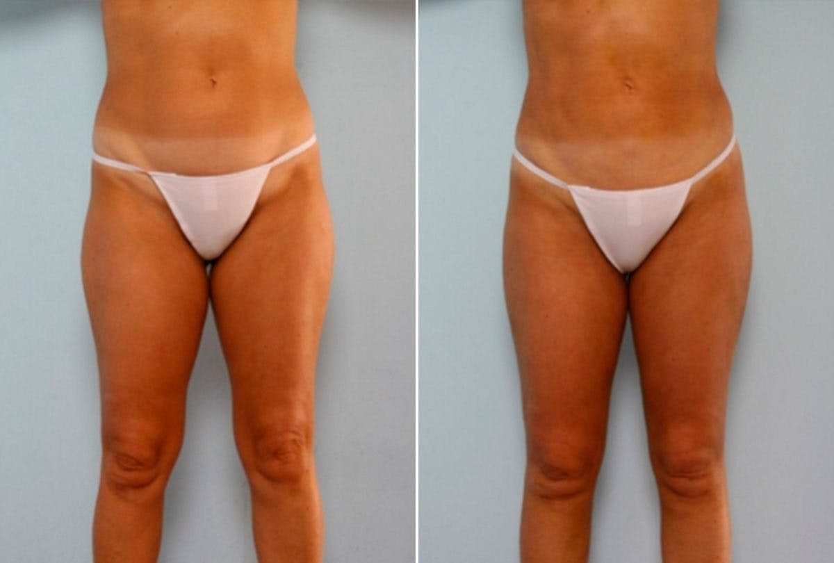 Female Liposuction Before & After Gallery - Patient 54870151 - Image 2