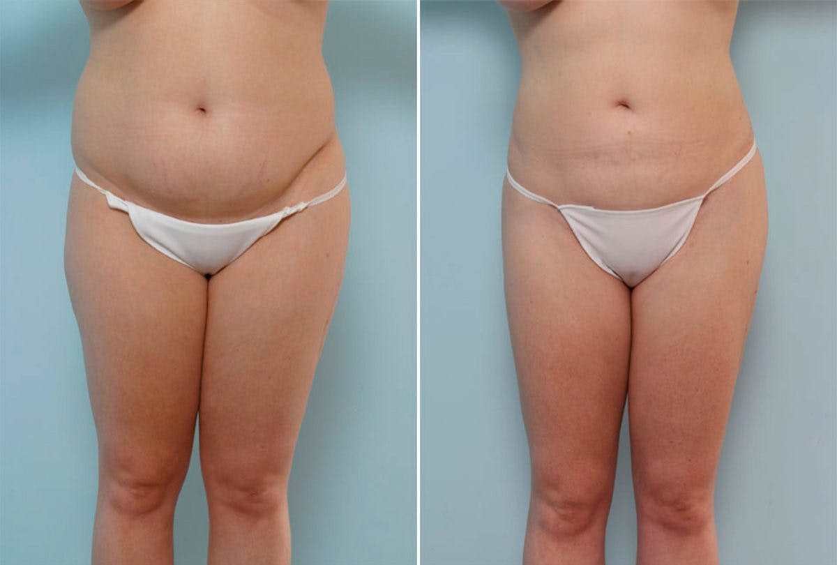 Female Liposuction Before & After Gallery - Patient 54870160 - Image 1
