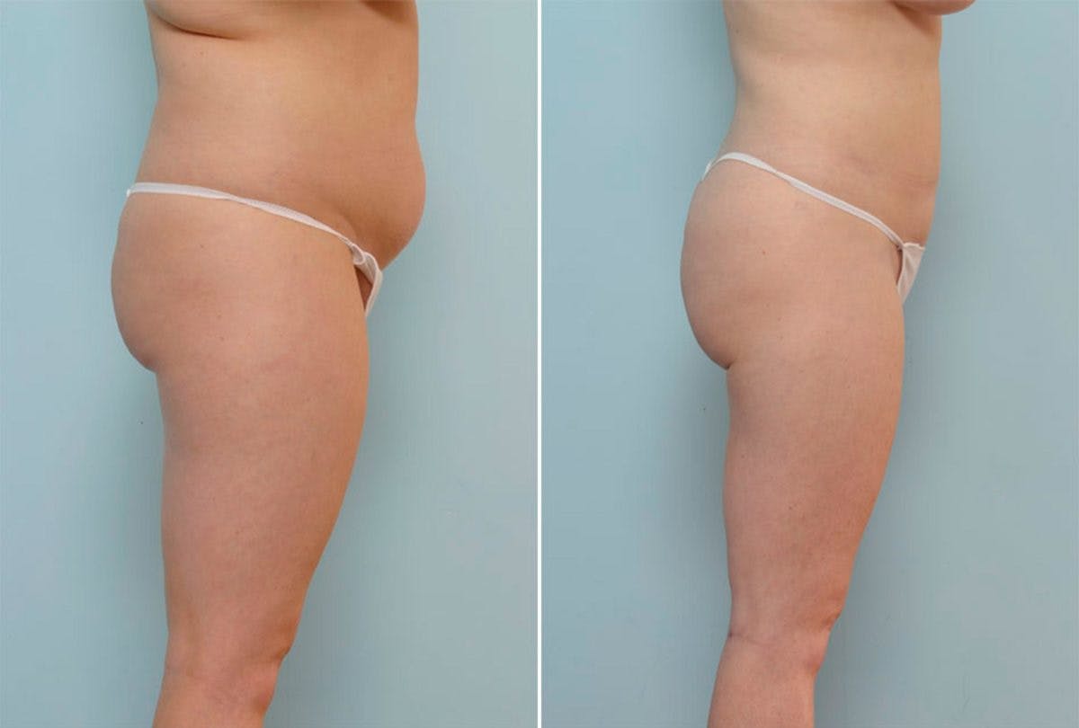 Female Liposuction Before & After Gallery - Patient 54870160 - Image 2
