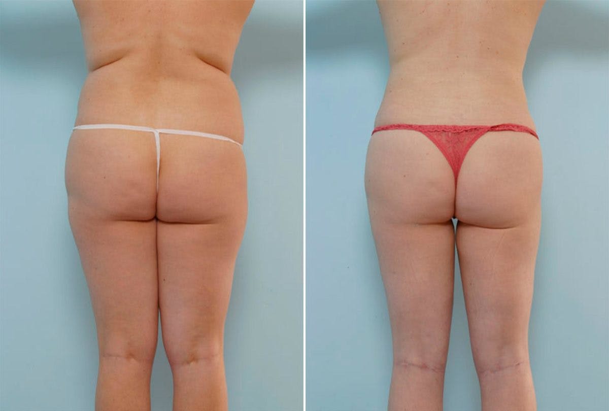 Female Liposuction Before & After Gallery - Patient 54870160 - Image 3