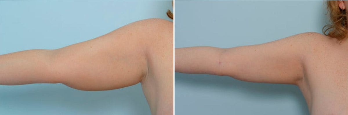 Female Liposuction Before & After Gallery - Patient 54870160 - Image 4