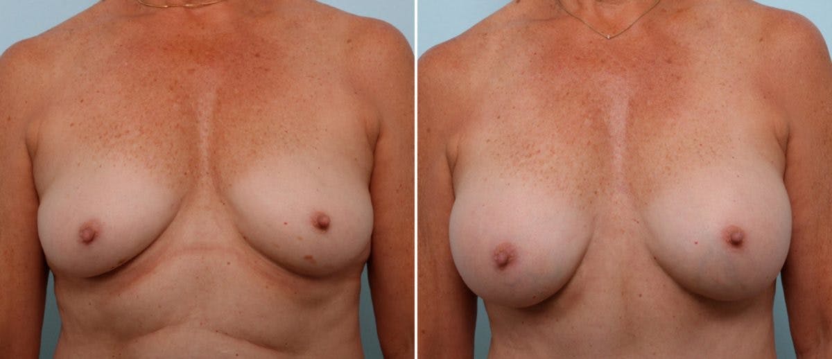 Mommy Makeover Before & After Photo - Patient 54870165 - Image 1