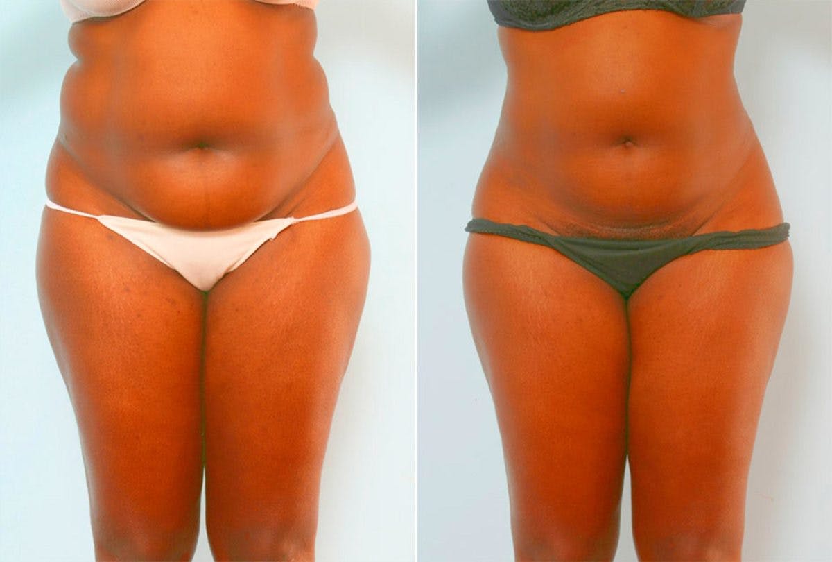 Female Liposuction Before & After Gallery - Patient 54870167 - Image 1