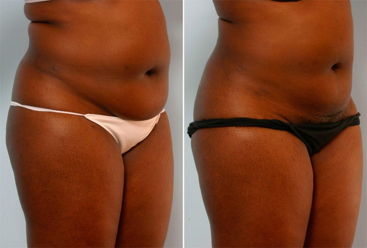 Female Liposuction Before & After Gallery - Patient 54870167 - Image 2