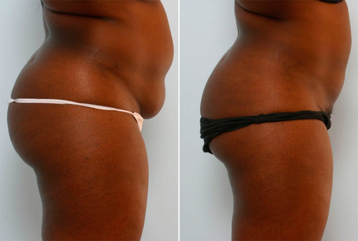 Female Liposuction Before & After Gallery - Patient 54870167 - Image 3