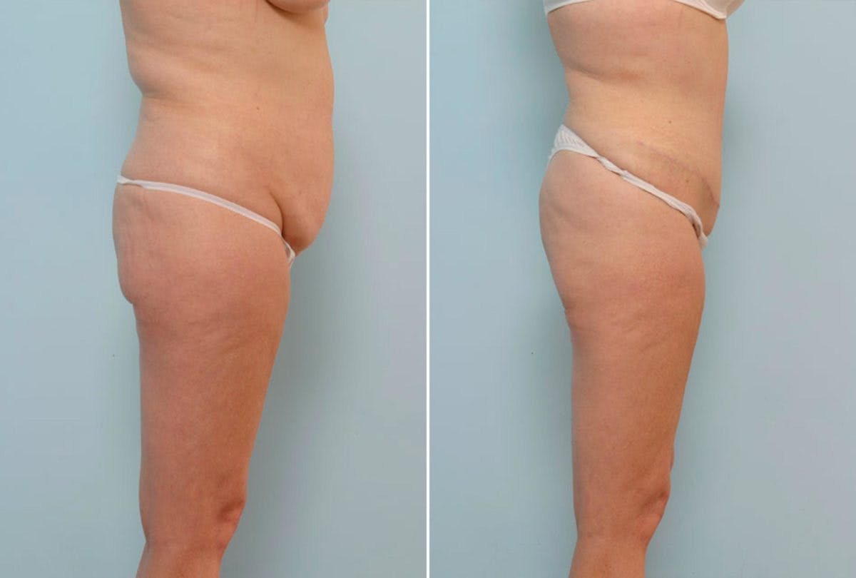 Abdominoplasty Before & After Gallery - Patient 54870168 - Image 3