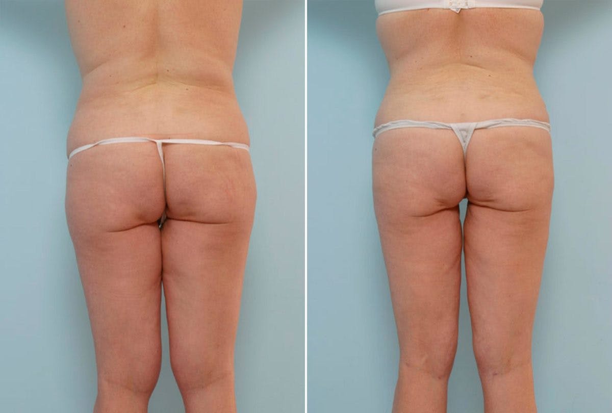 Abdominoplasty Before & After Gallery - Patient 54870168 - Image 4
