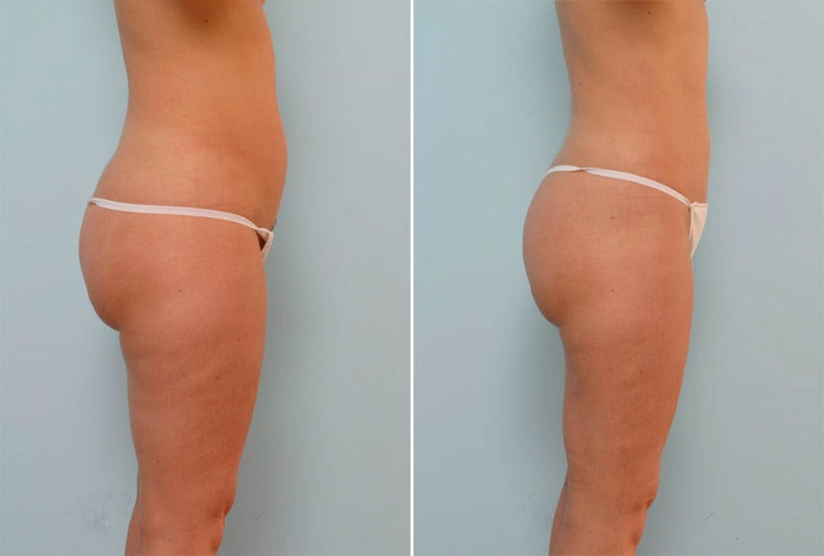 Female Liposuction Before & After Gallery - Patient 54870169 - Image 2