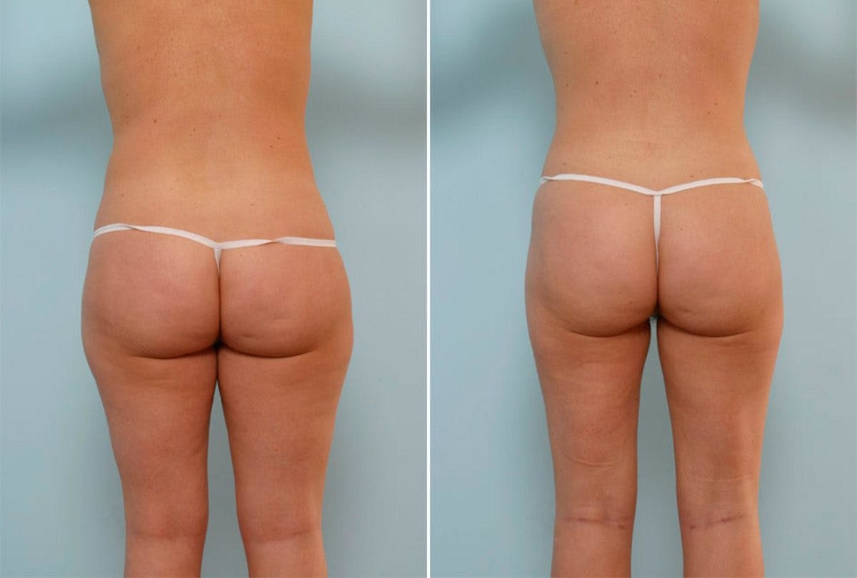 Female Liposuction Before & After Gallery - Patient 54870169 - Image 3