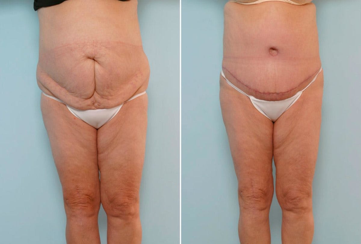 Abdominoplasty Before & After Gallery - Patient 54870173 - Image 1