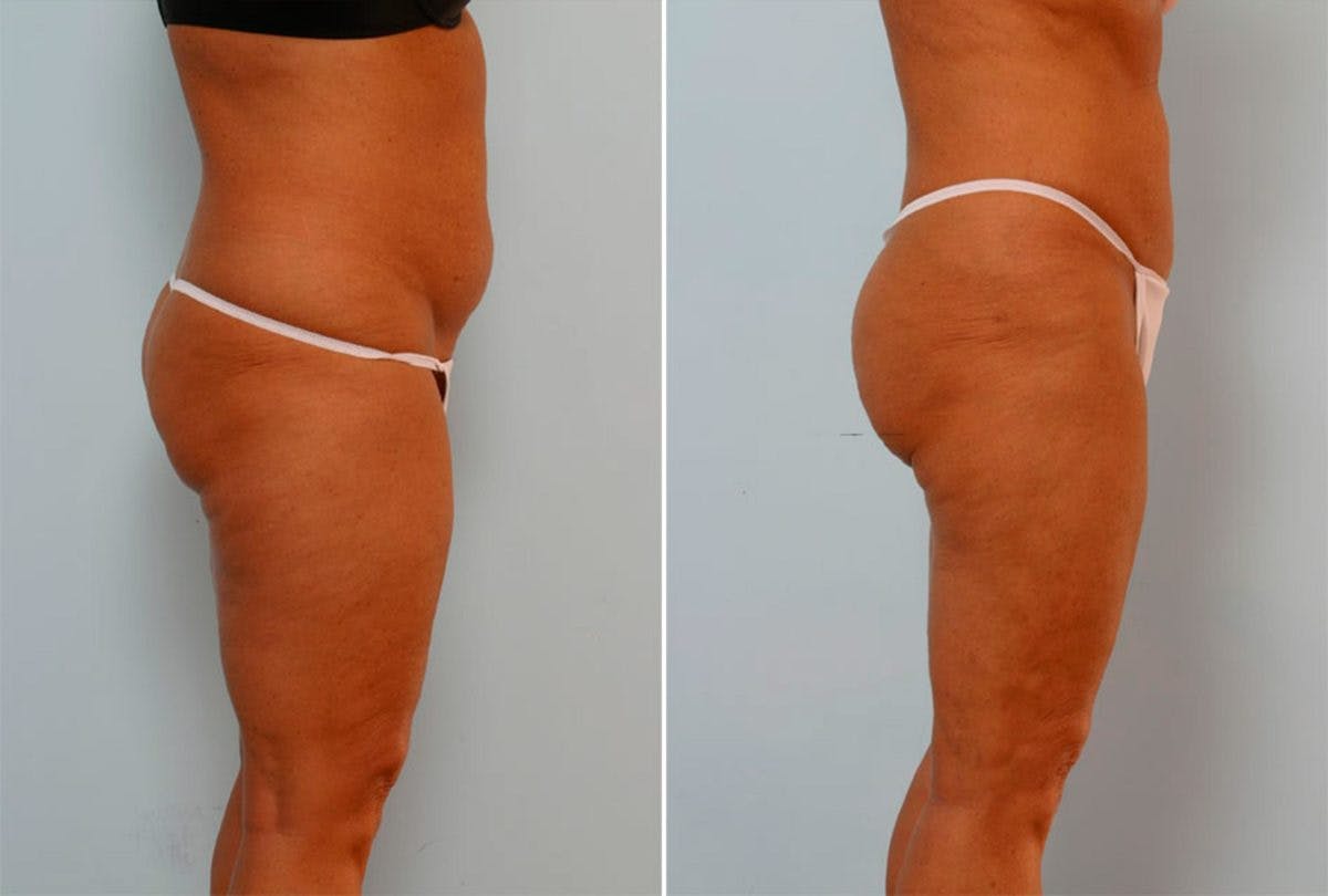 Female Liposuction Before & After Photo - Patient 54870174 - Image 2