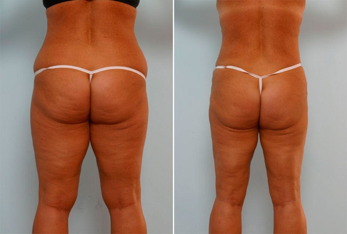 Female Liposuction Before & After Photo - Patient 54870174 - Image 3