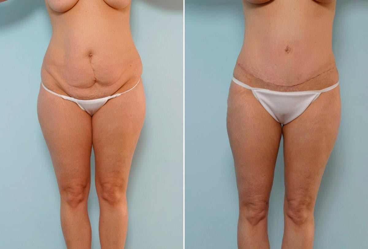 Abdominoplasty Before & After Gallery - Patient 54870925 - Image 1