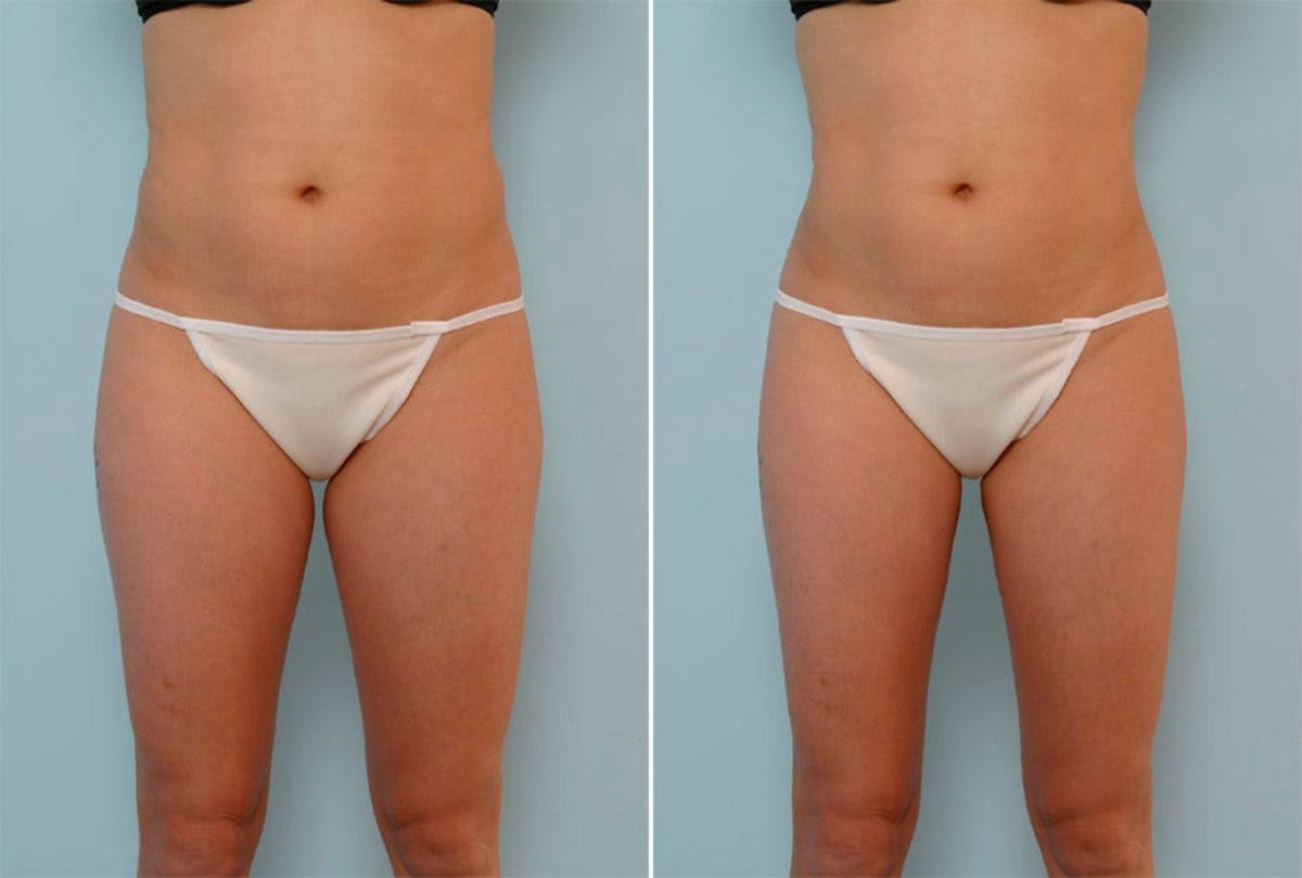 Female Liposuction Before & After Gallery - Patient 54870926 - Image 1