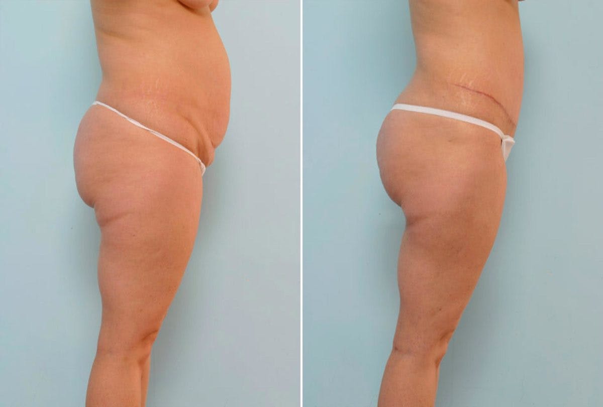 Abdominoplasty Before & After Gallery - Patient 54870925 - Image 3