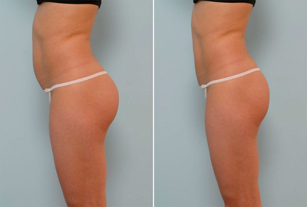 Female Liposuction Before & After Gallery - Patient 54870926 - Image 2