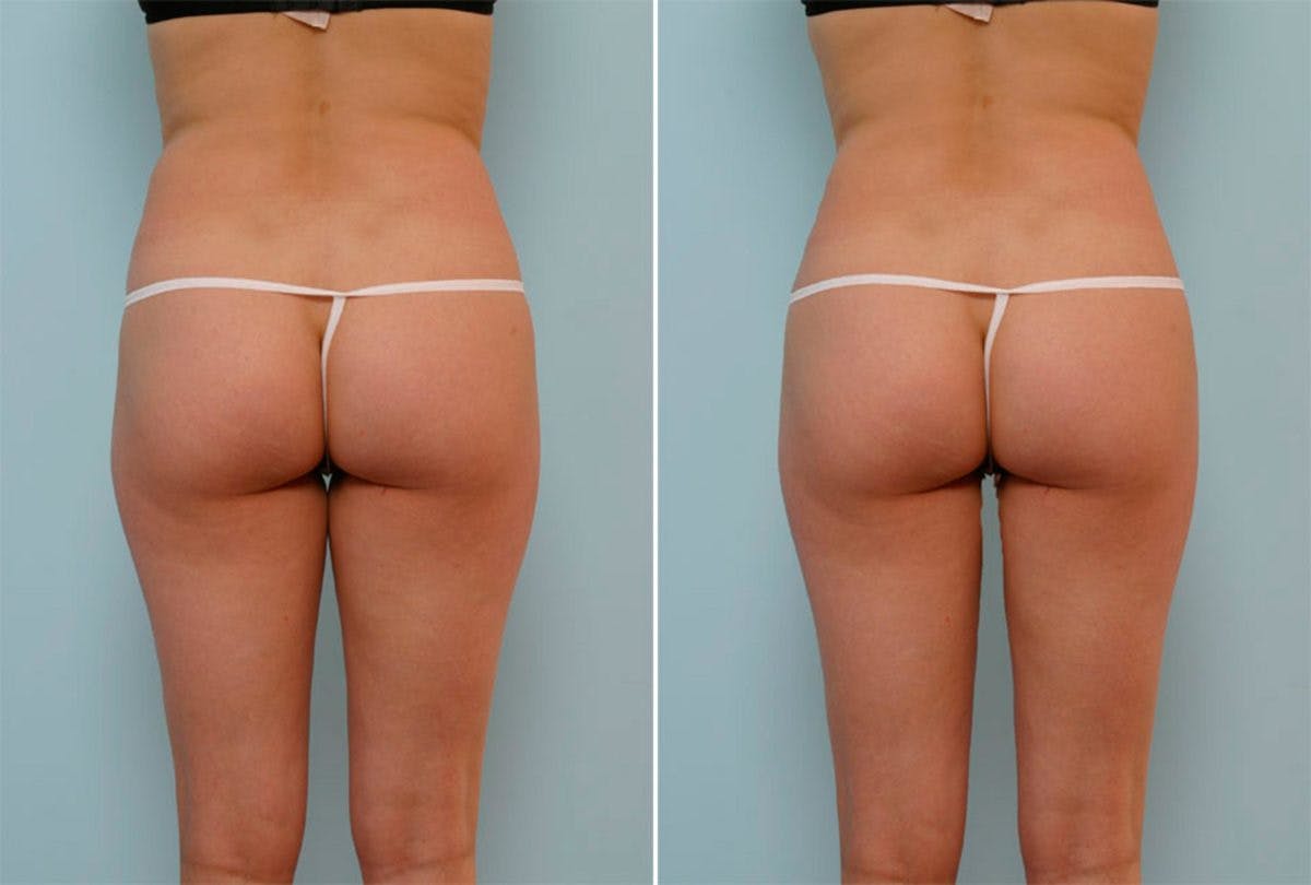 Female Liposuction Before & After Gallery - Patient 54870926 - Image 3
