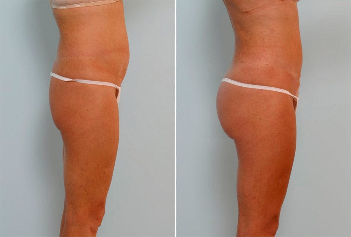 Female Liposuction Before & After Photo - Patient 54870928 - Image 2