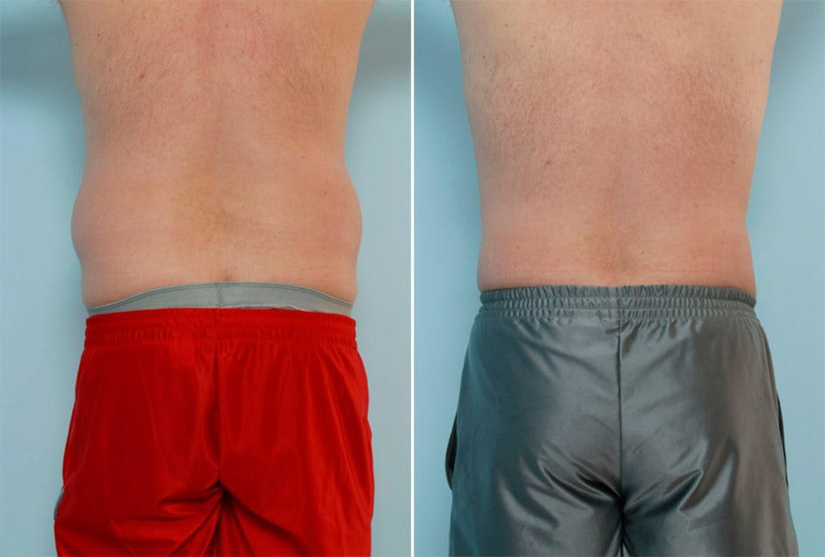 Female Liposuction Before & After Photo - Patient 54870938 - Image 3