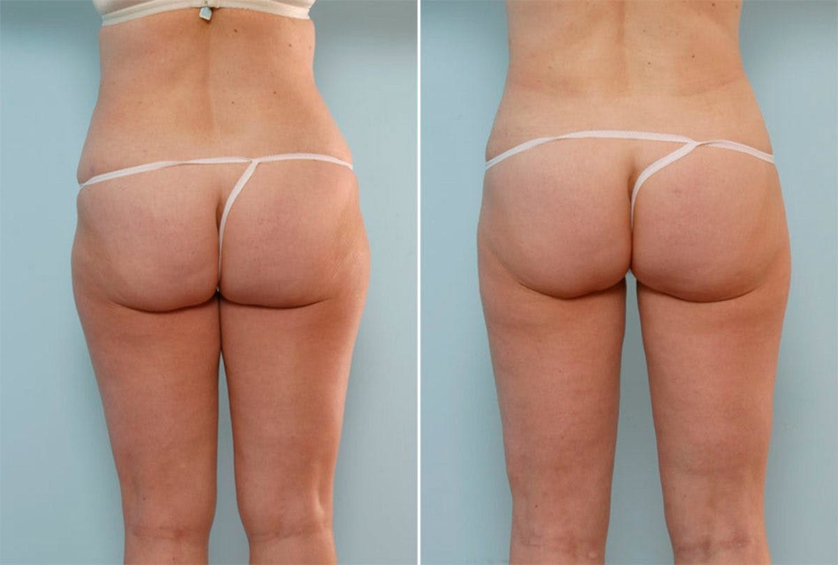 Female Liposuction Before & After Photo - Patient 54870942 - Image 3