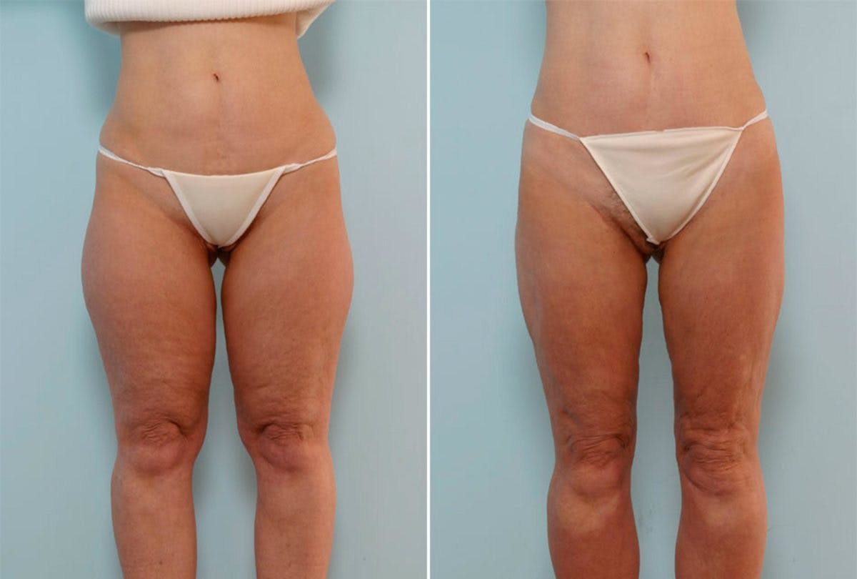 Female Liposuction Before & After Gallery - Patient 54871947 - Image 1