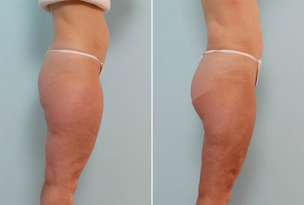 Female Liposuction Before & After Gallery - Patient 54871947 - Image 2
