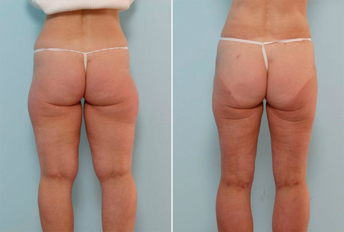 Female Liposuction Before & After Gallery - Patient 54871947 - Image 3