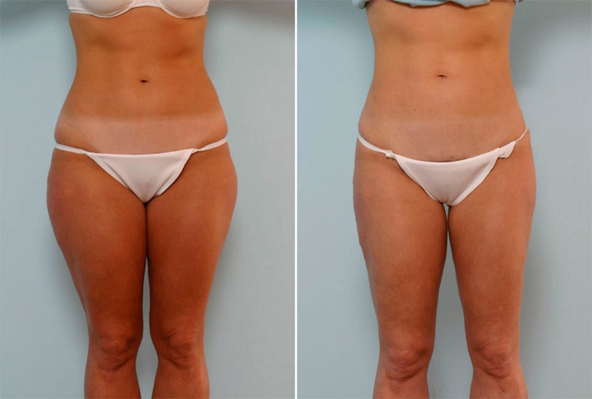 Female Liposuction Before & After Gallery - Patient 54871950 - Image 1